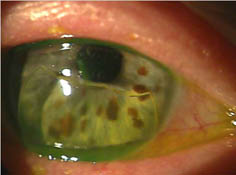 Broken Gas Permeable lens on Eye